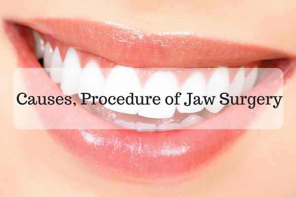 Causes, Procedure and recovery of corrective Jaw Surgery