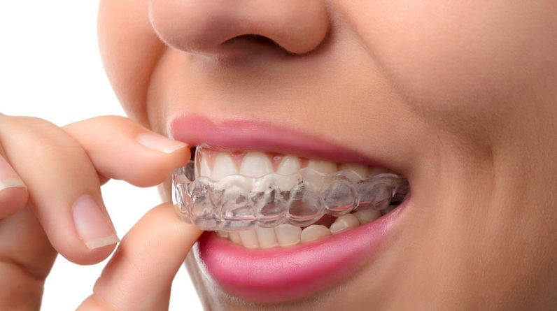Woman wearing orthodontic silicone trainer